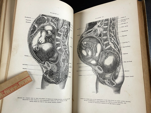1876 Midwifery 1st, Playfair, Pregnancy Birth Obstetrics, Leather Medical Book - RARE